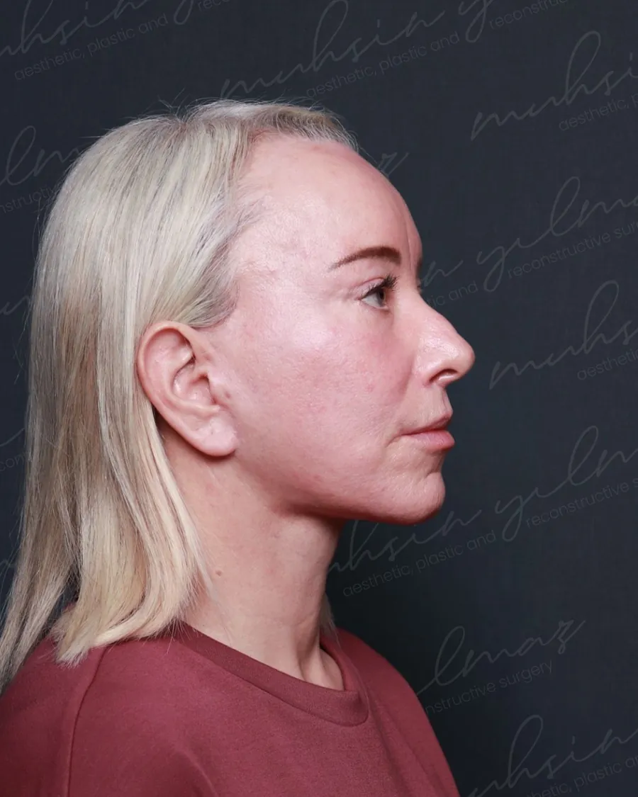 After revision extended deep plane face and neck lift and upper and lower blepharoplasty, profile view, 55-year-old woman