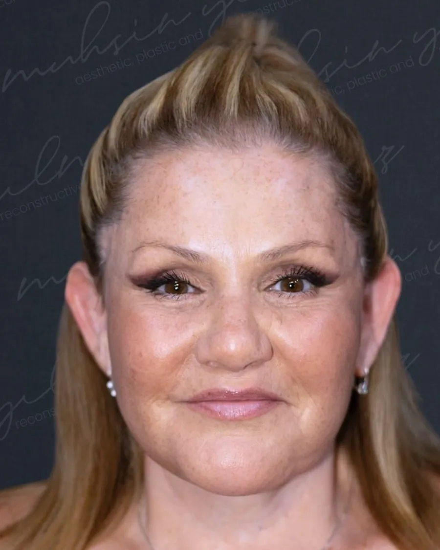 After extended deep plane face and neck lift and endoscopic forehead lift, front view, woman