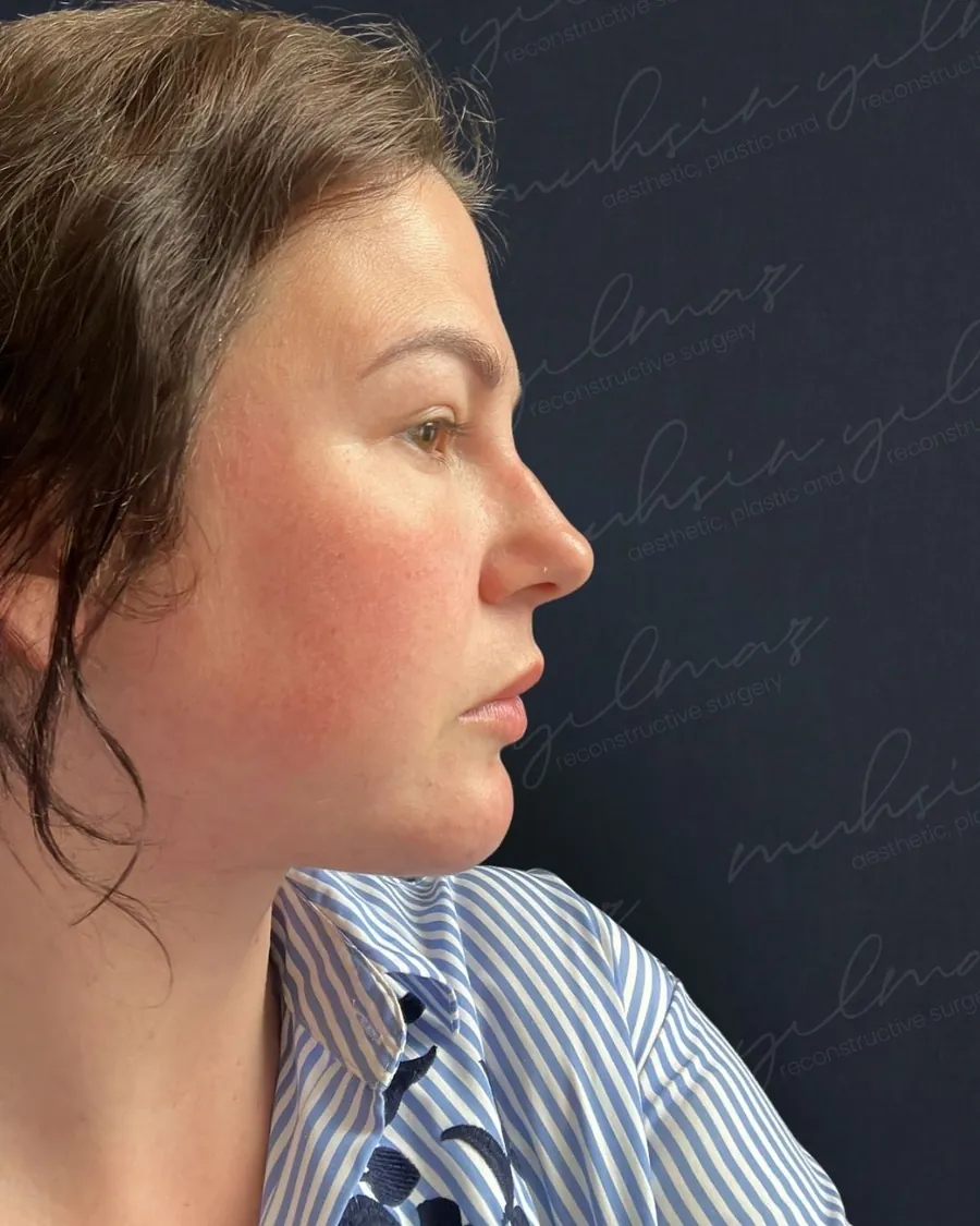 After deep neck shaping and neck lift, profile view, 47-year-old woman