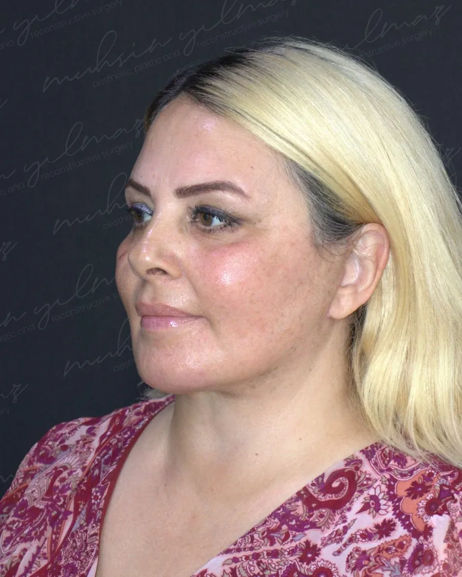 After facelift and neck lift, three-quarter view, woman