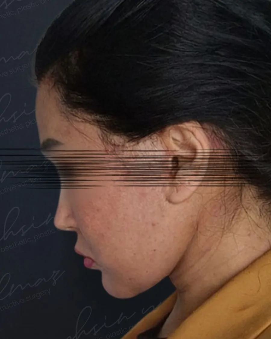 After extended deep plane facelift and deep neck shaping and neck lift, head-down view, 40-year-old woman
