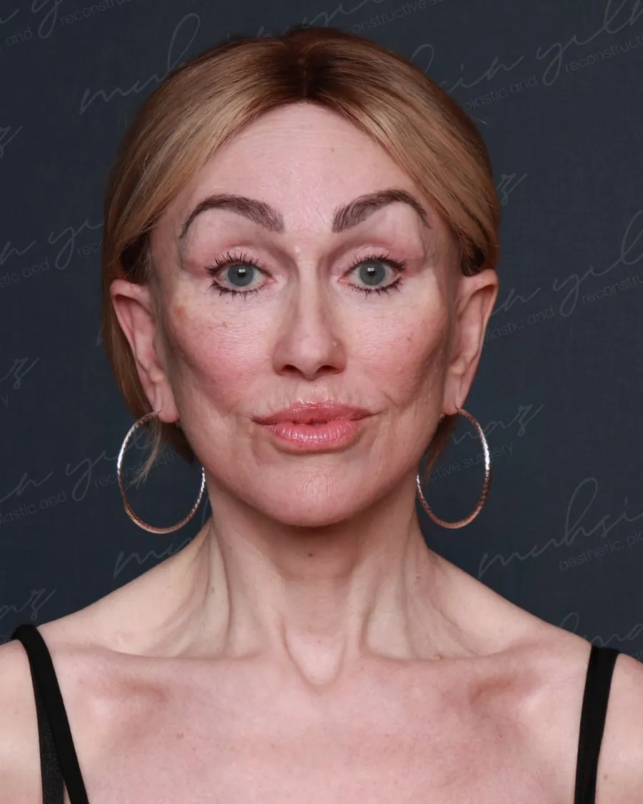 Eight months after extended deep plane face and neck lift and upper and lower blepharoplasty, front view, 56-year-old woman