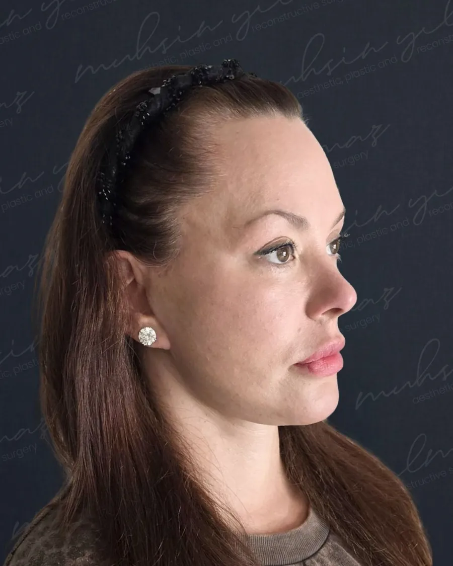 Six months after extended deep plane facelift and deep neck lift, three-quarter view, 58-year-old woman