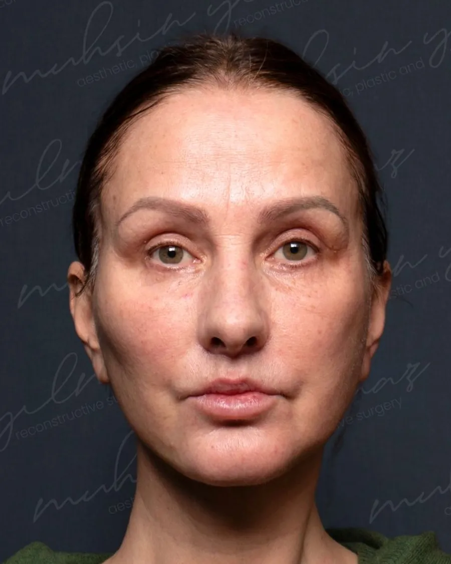 After extended deep plane face and neck lift and upper and lower blepharoplasty, front view, 57-year-old woman