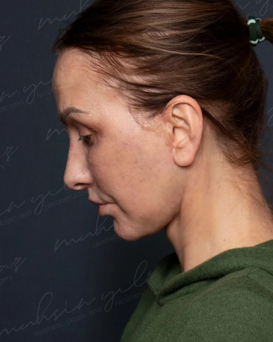 After extended deep plane face and neck lift and upper and lower blepharoplasty, head-down view, 57-year-old woman