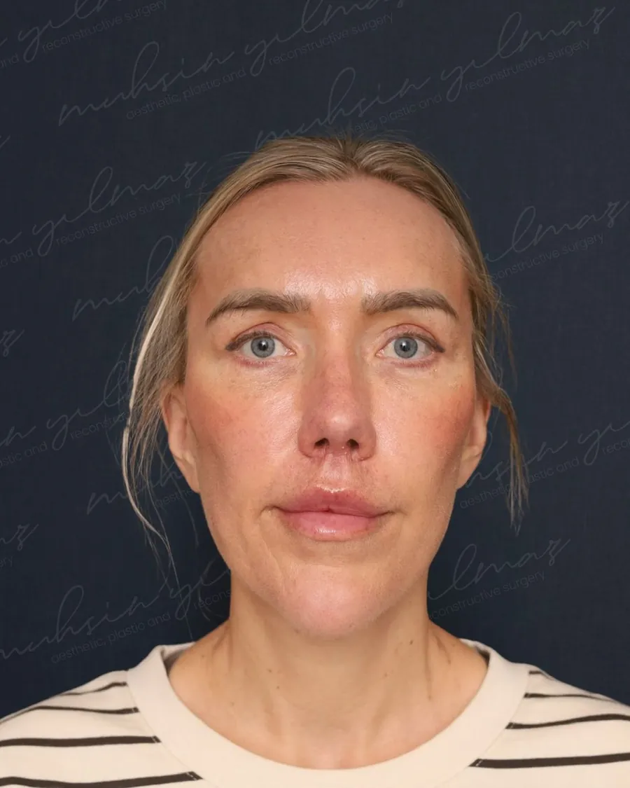After extended deep plane facelift and deep neck sculpting and neck lift, front view, 42-year-old woman