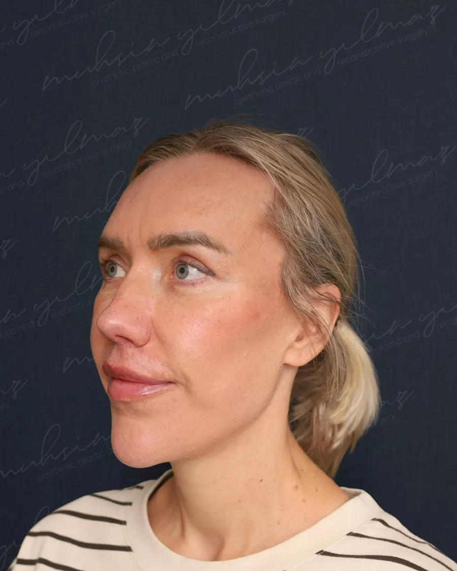 After extended deep plane facelift and deep neck sculpting and neck lift, three-quarter view, 42-year-old woman