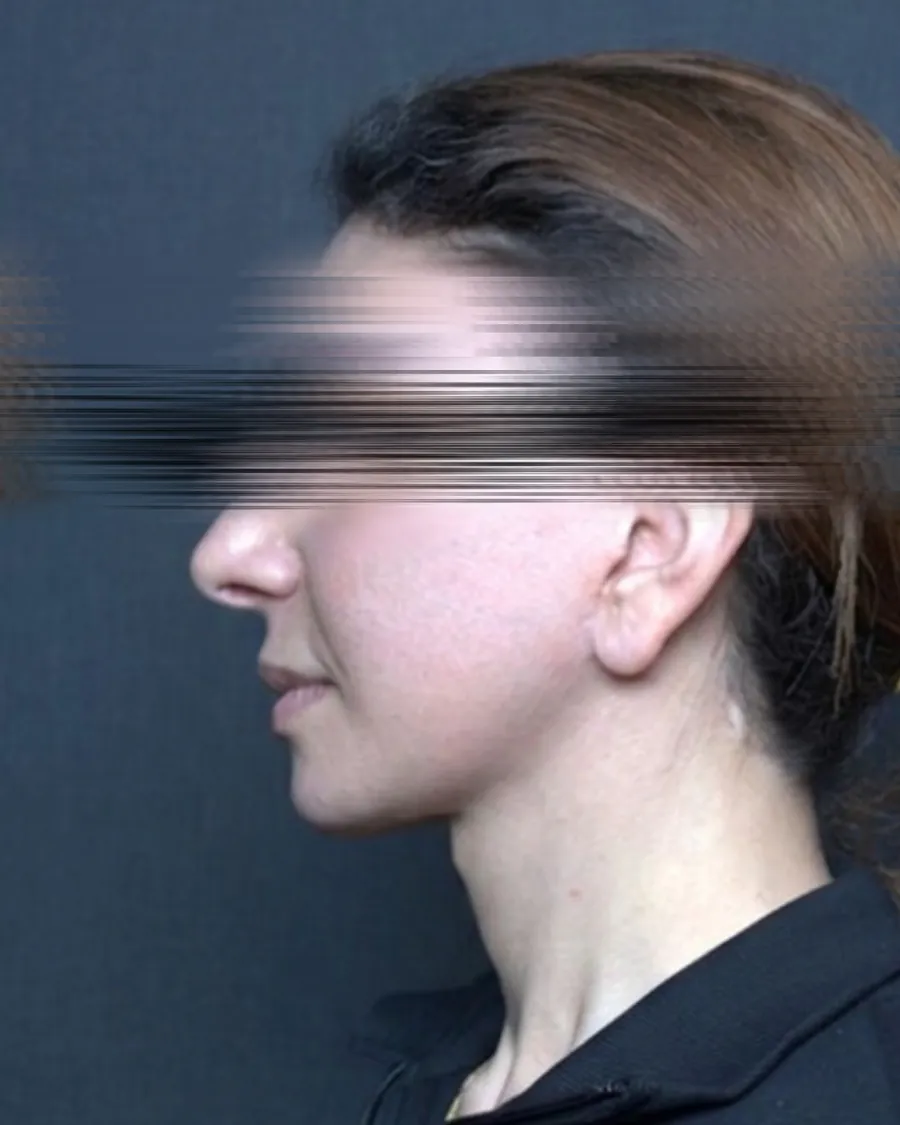 After extended deep plane facelift and neck lift, profile view, 42-year-old woman
