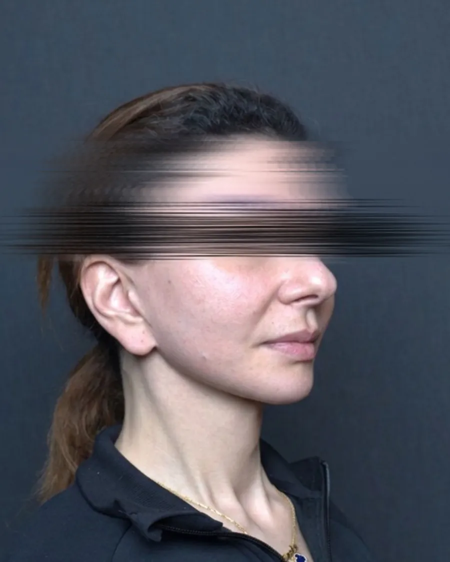 After extended deep plane facelift and neck lift, three-quarter view, 42-year-old woman