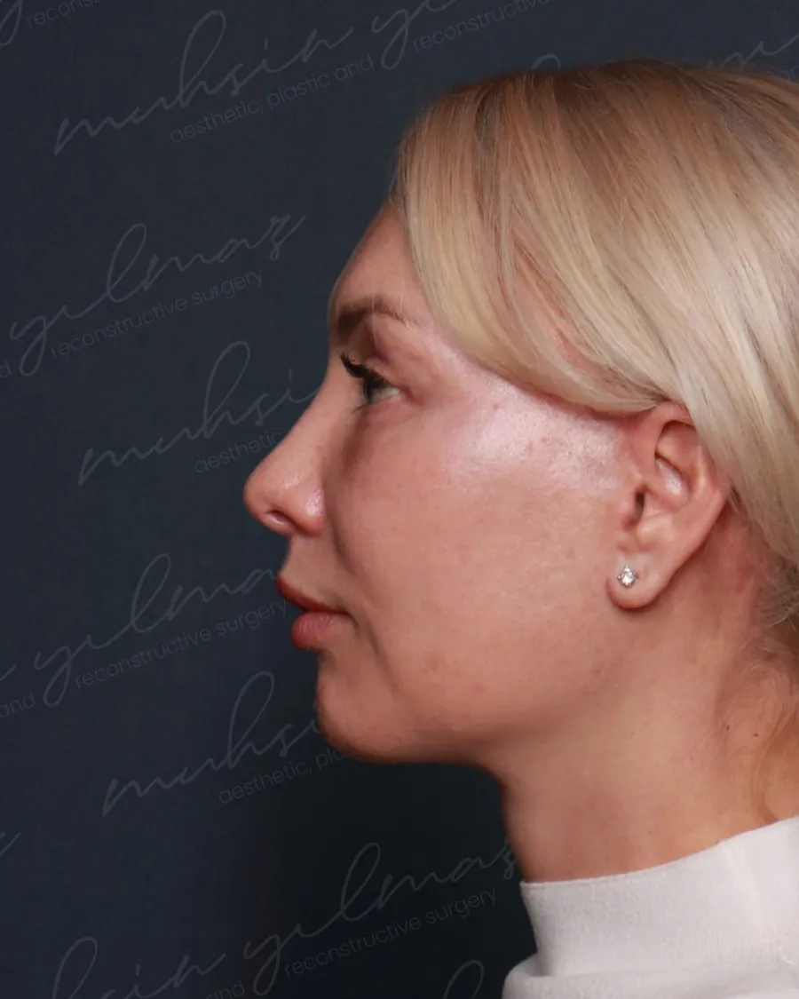 After extended deep plane face and neck lift and upper and lower blepharoplasty, profile view, 54-year-old woman