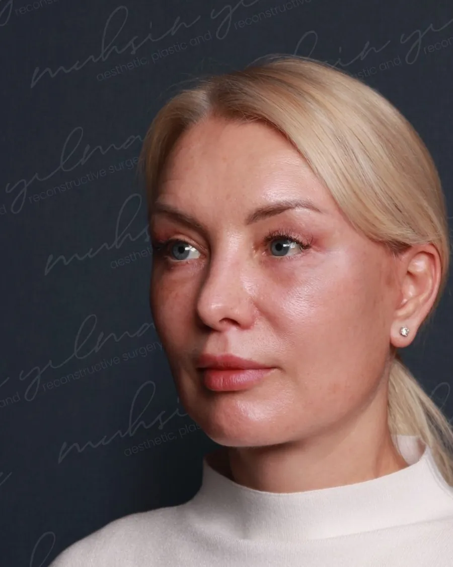 After extended deep plane face and neck lift and upper and lower blepharoplasty, three-quarter view, 54-year-old woman