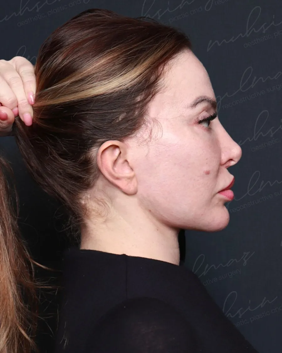 After revision extended deep plane face and neck lift and deep neck sculpting, profile view, 42-year-old woman