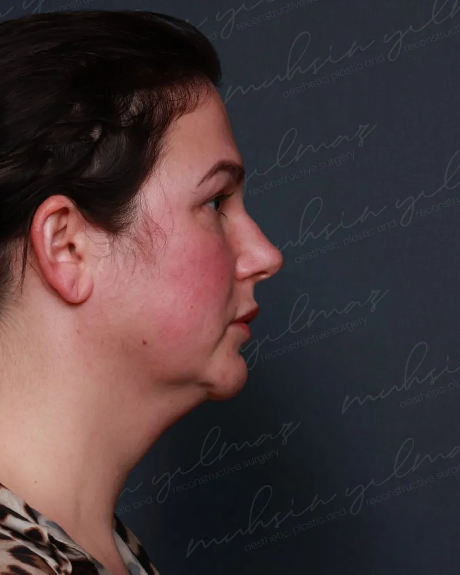 Before deep neck shaping and neck lift, profile view, 47-year-old woman