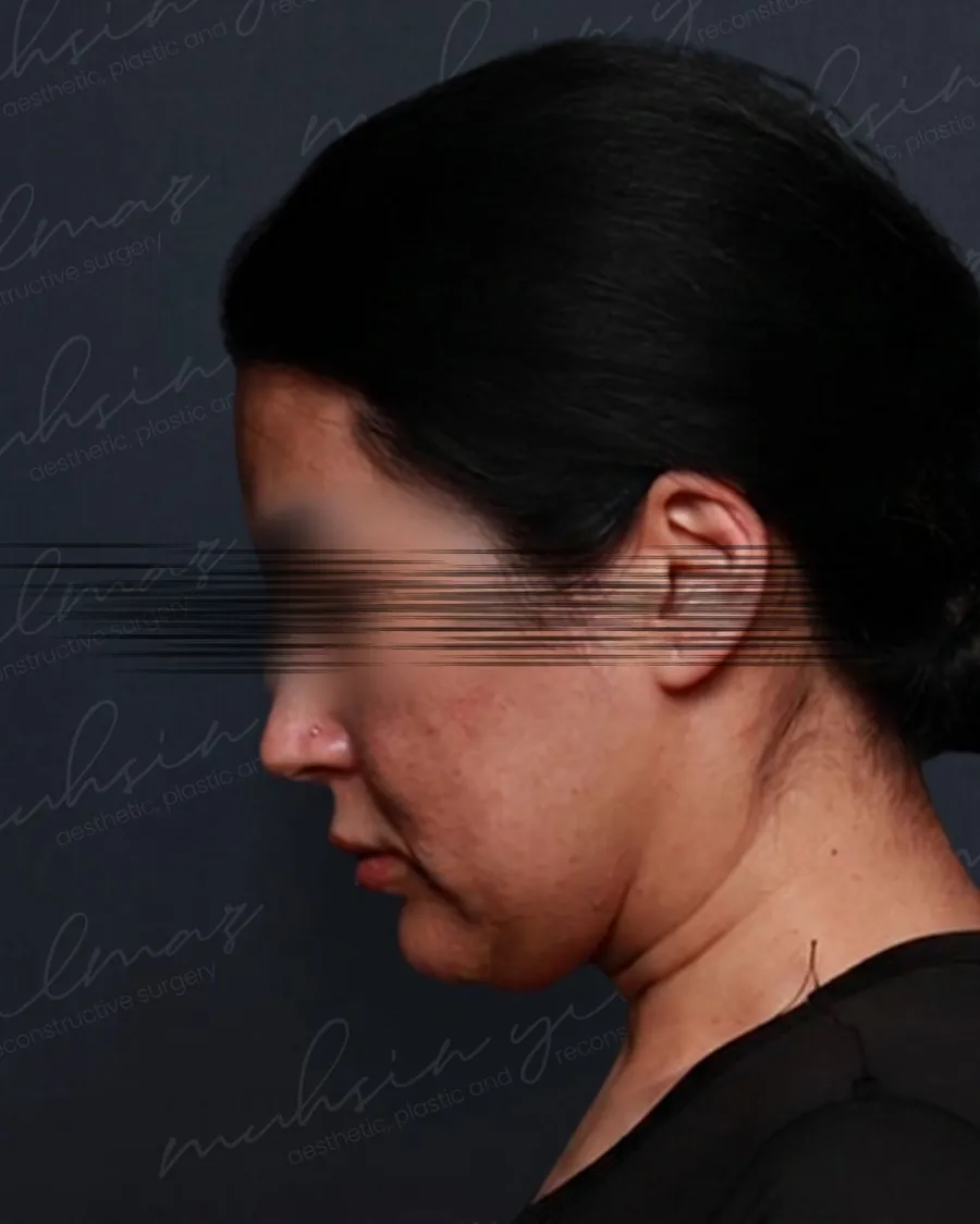 Before extended deep plane facelift and deep neck shaping and neck lift, head-down view, 40-year-old woman