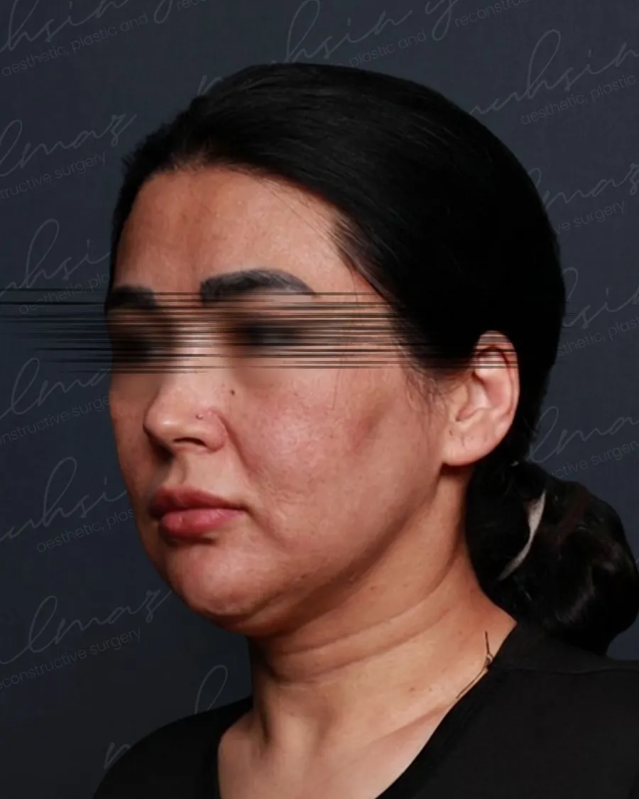 Before extended deep plane facelift and deep neck shaping and neck lift, three-quarter view, 40-year-old woman