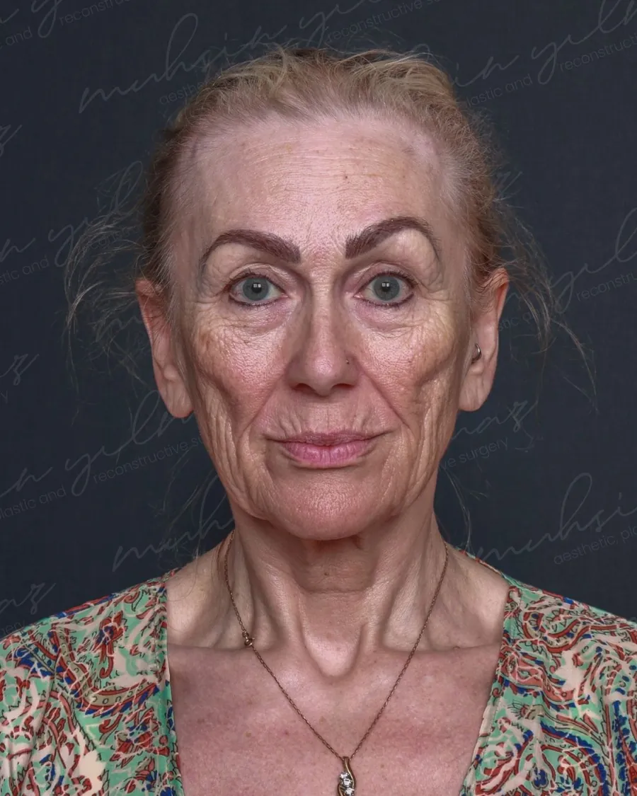 Before extended deep plane face and neck lift and upper and lower blepharoplasty, front view, 56-year-old woman