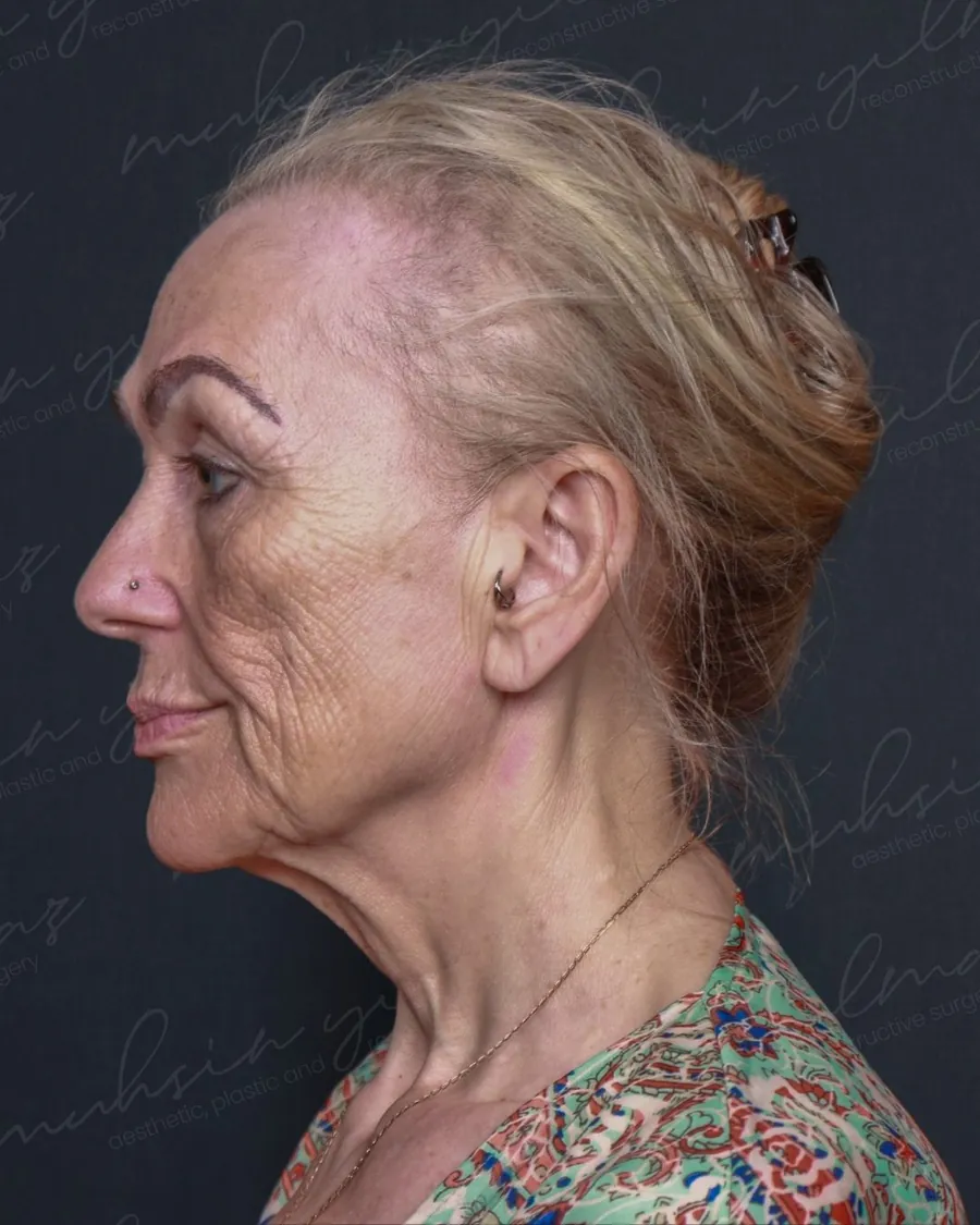 Before extended deep plane face and neck lift and upper and lower blepharoplasty, profile view, 56-year-old woman