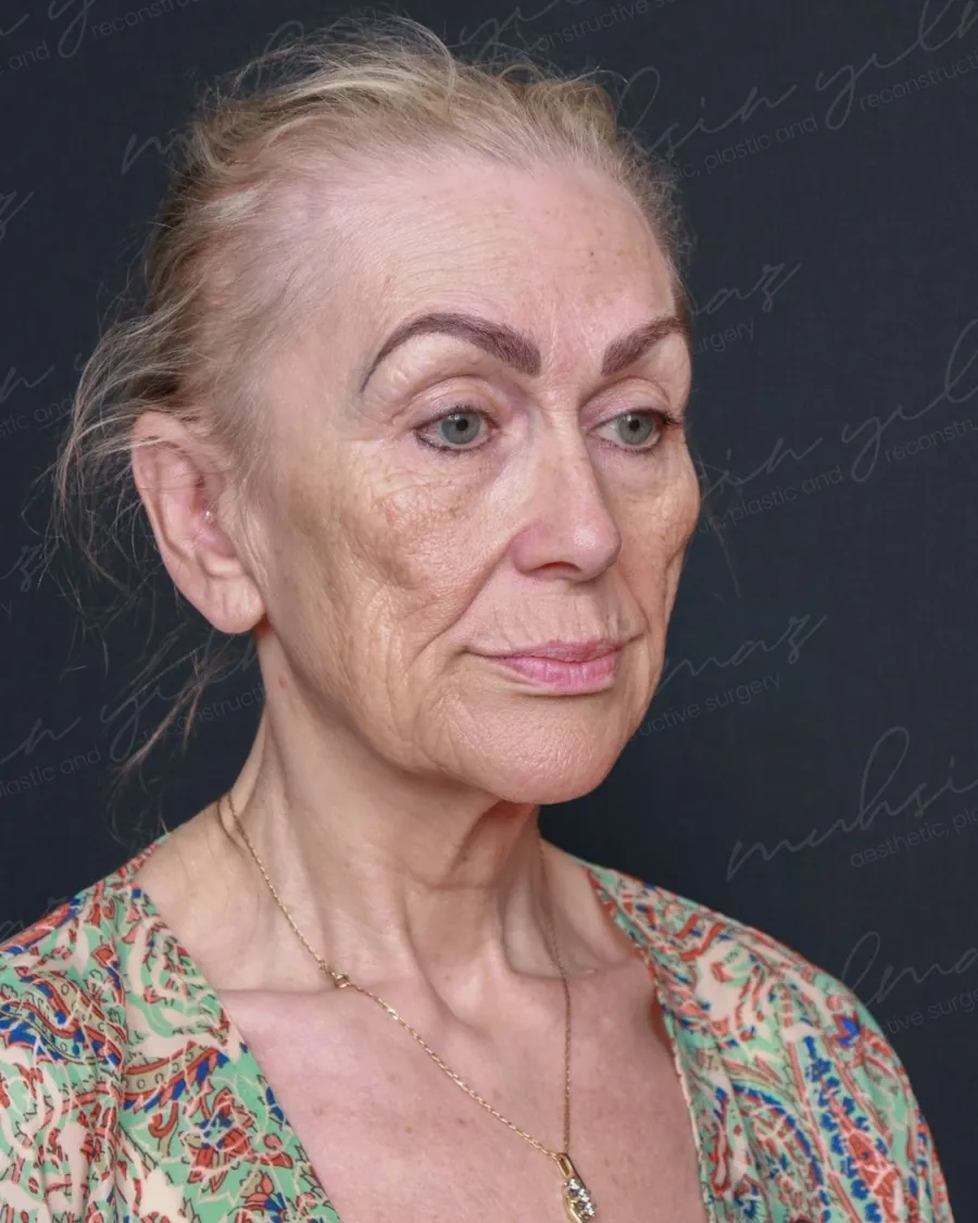 Before extended deep plane face and neck lift and upper and lower blepharoplasty, three-quarter view, 56-year-old woman