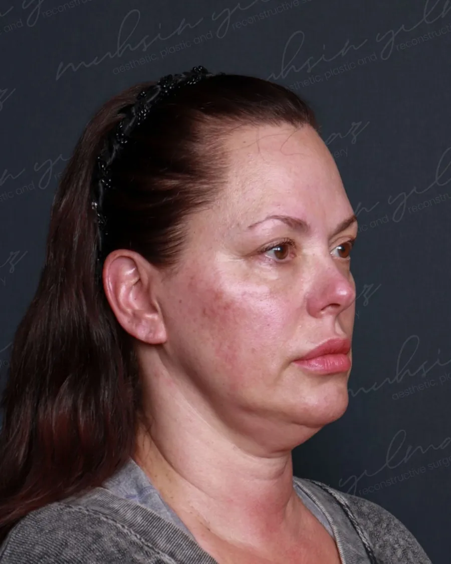 Before extended deep plane facelift and deep neck lift, three-quarter view, 58-year-old woman