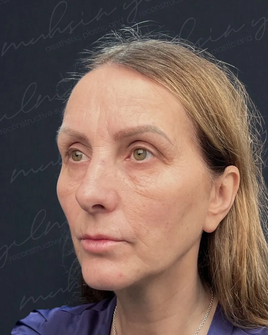 Before extended deep plane face and neck lift and upper and lower blepharoplasty, three-quarter view, 57-year-old woman