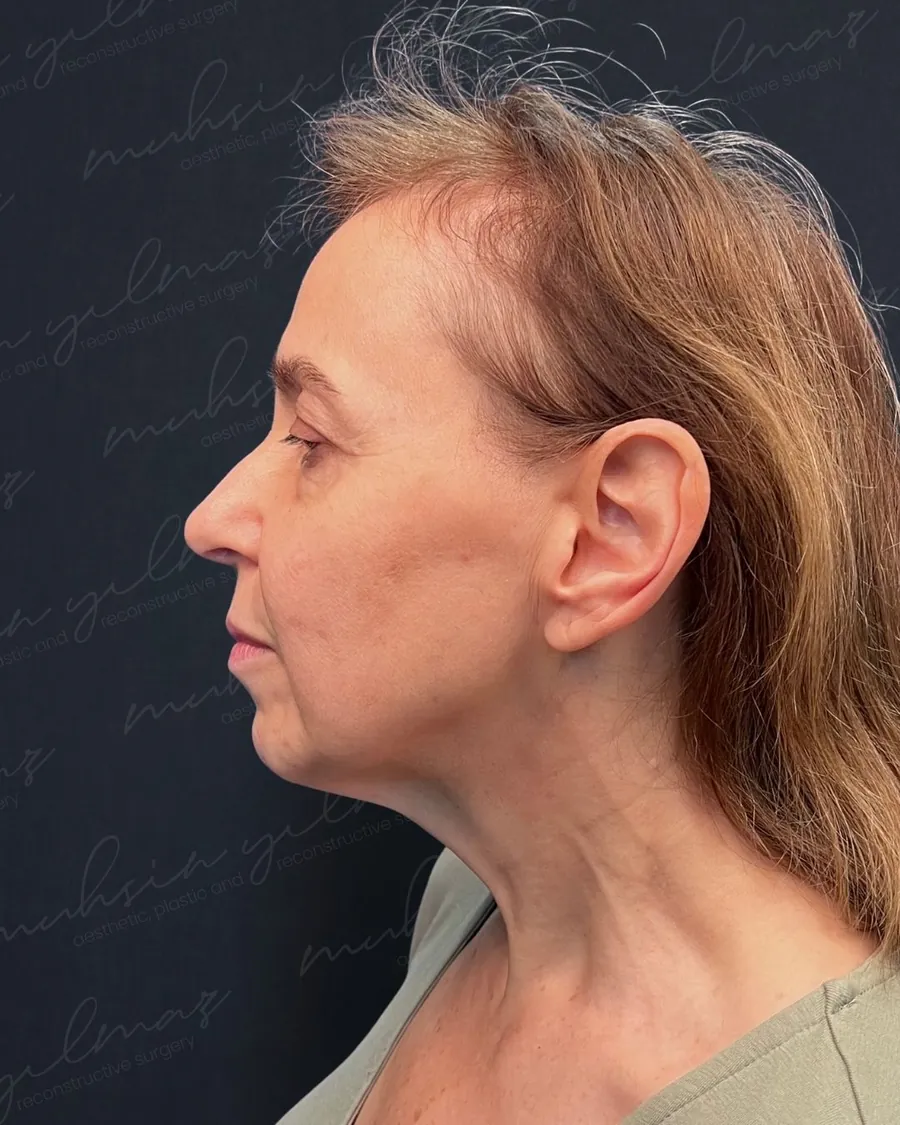 Before extended deep plane facelift and deep neck lift, profile view, woman