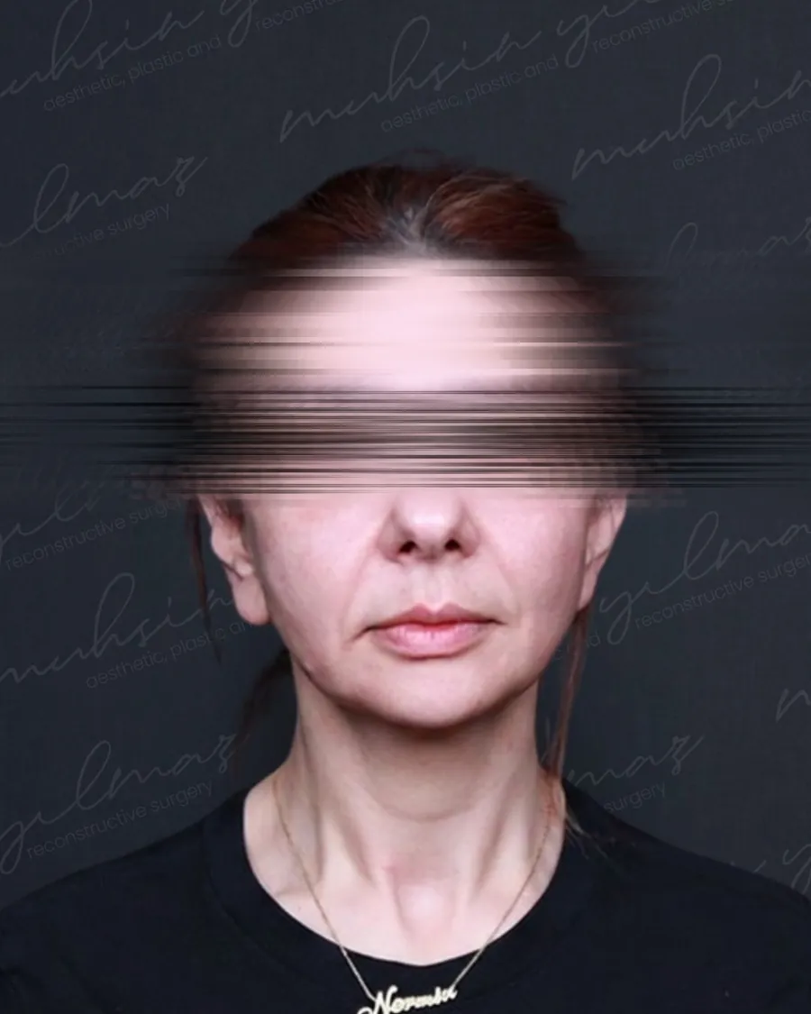 Before extended deep plane facelift and neck lift, front view, 42-year-old woman