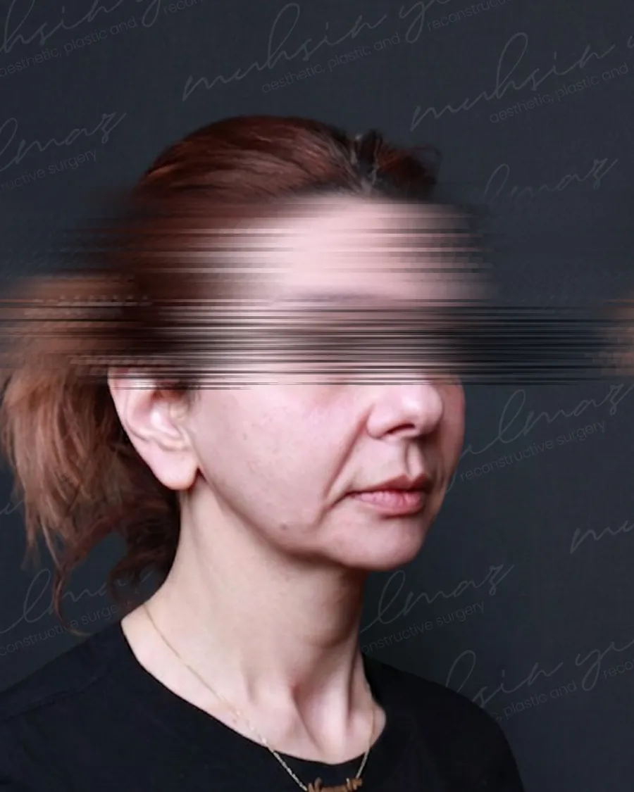 Before extended deep plane facelift and neck lift, three-quarter view, 42-year-old woman