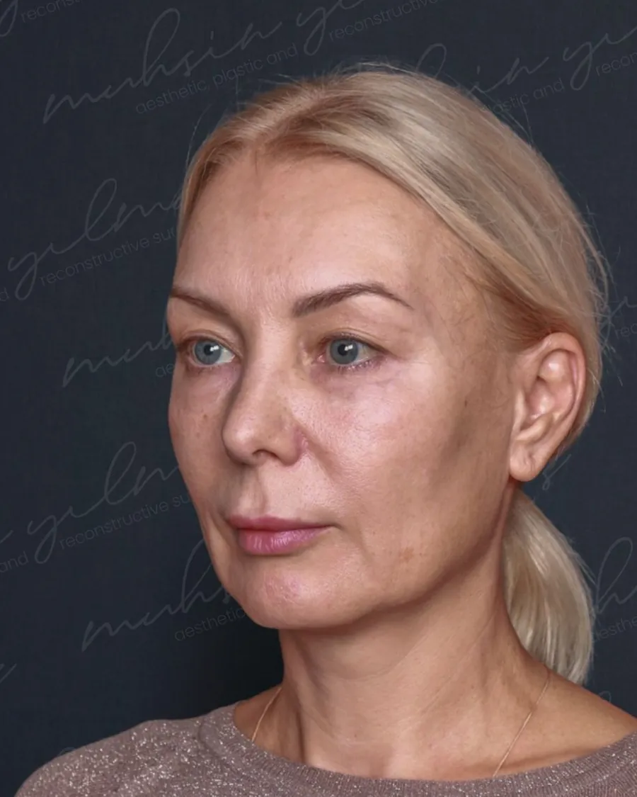 Before extended deep plane face and neck lift and upper and lower blepharoplasty, three-quarter view, 54-year-old woman