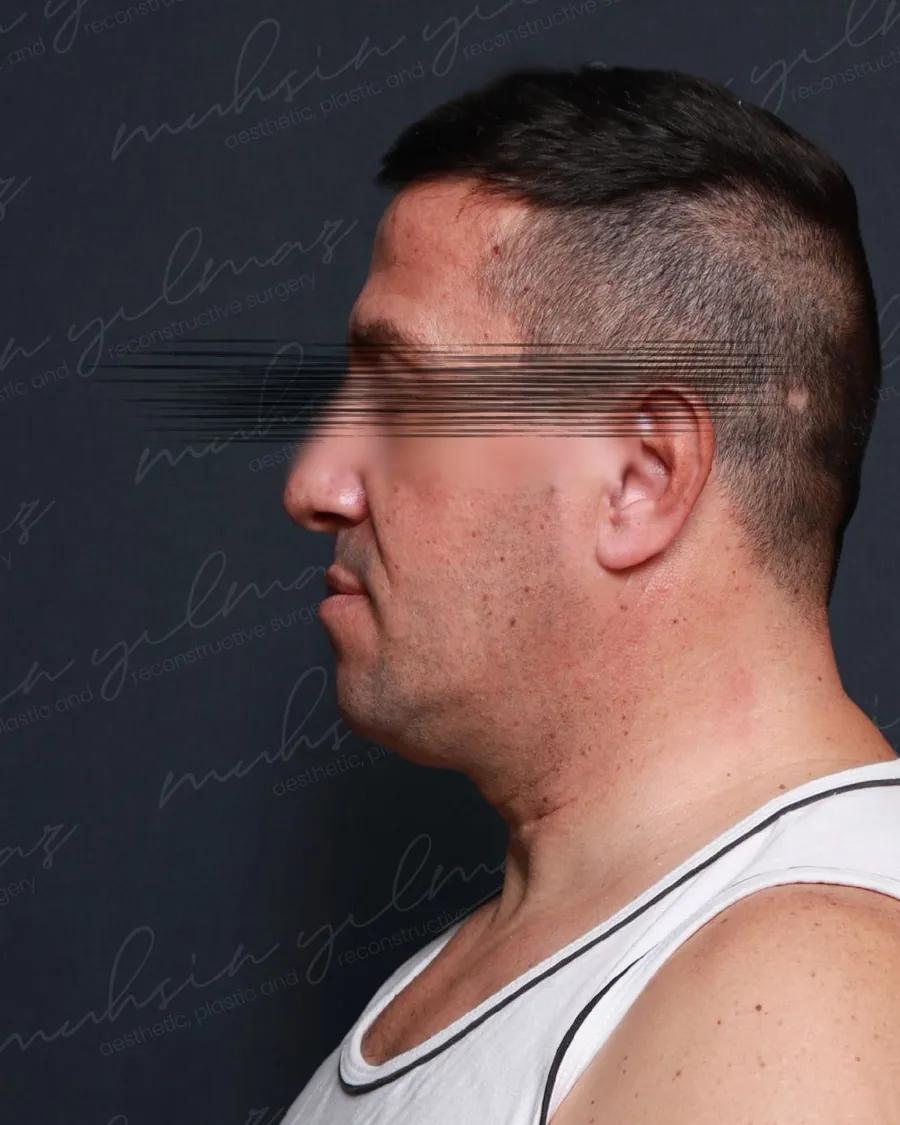 Before facelift and neck lift, profile view, 47-year-old man